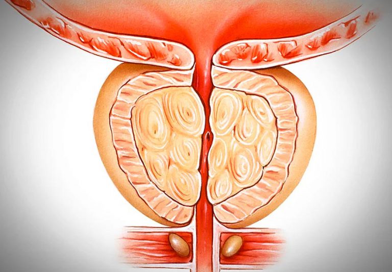 Cirurgia Rob Tica De Pr Stata Saiba Tudo Dr Paulo Maron