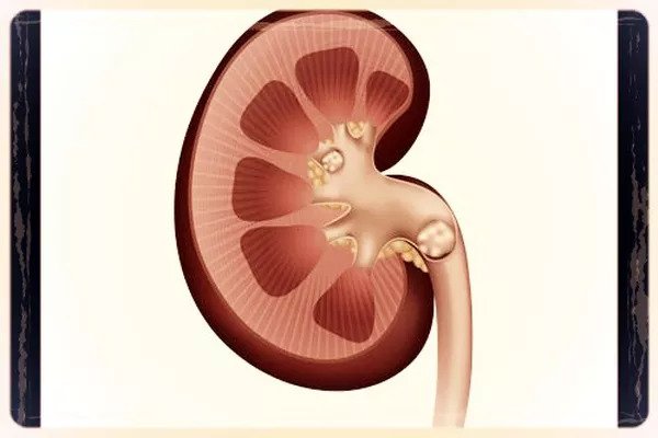 Cólica Renal. Nunca mais quero ter!