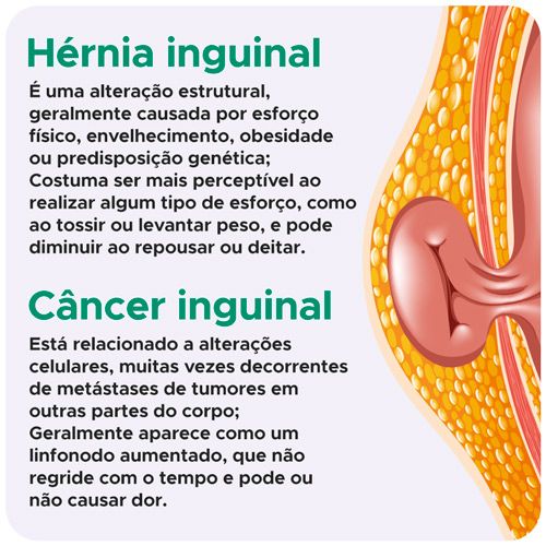 Hérnia inguinal x Câncer inguinal
Hérnia inguinal
É uma alteração estrutural, geralmente causada por esforço físico, envelhecimento, obesidade ou predisposição genética;
Costuma ser mais perceptível ao realizar algum tipo de esforço, como ao tossir ou levantar peso, e pode diminuir ao repousar ou deitar.
Câncer inguinal
Está relacionado a alterações celulares, muitas vezes decorrentes de metástases de tumores em outras partes do corpo;
Geralmente aparece como um linfonodo aumentado, que não regride com o tempo e pode ou não causar dor.
