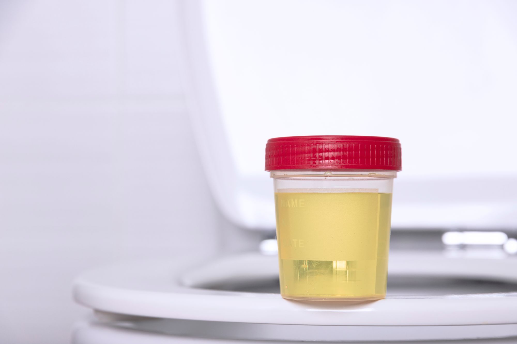 Pote com urina para realizar exame laboratorial urinálise para verificar a presença de sangue na urina.