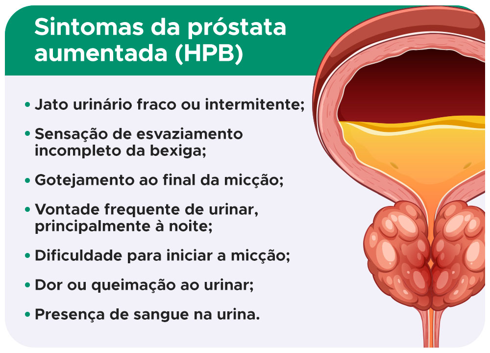 Sintomas da próstata aumentada (HPB)
Jato urinário fraco ou intermitente;
Sensação de esvaziamento incompleto da bexiga;
Gotejamento ao final da micção;
Vontade frequente de urinar, principalmente à noite;
Dificuldade para iniciar a micção;
Dor ou queimação ao urinar;
Presença de sangue na urina.
