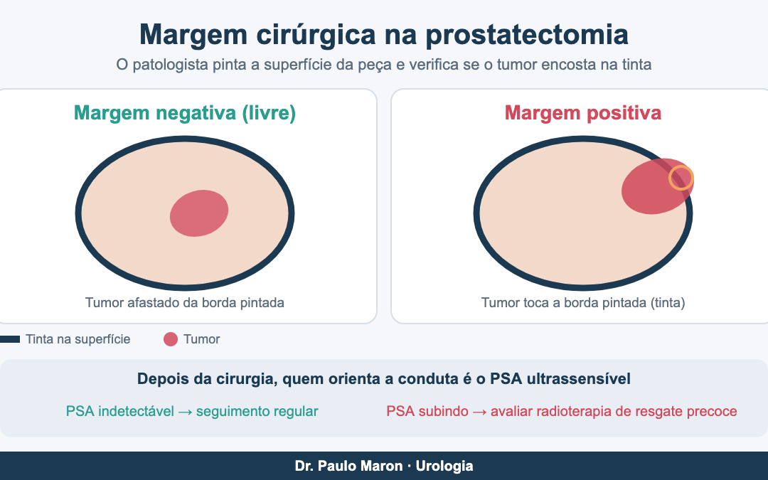 Margem cirúrgica positiva: o que significa após a prostatectomia?