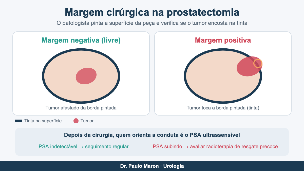 Margem cirúrgica positiva e negativa na prostatectomia: esquema do tumor em relação à borda pintada