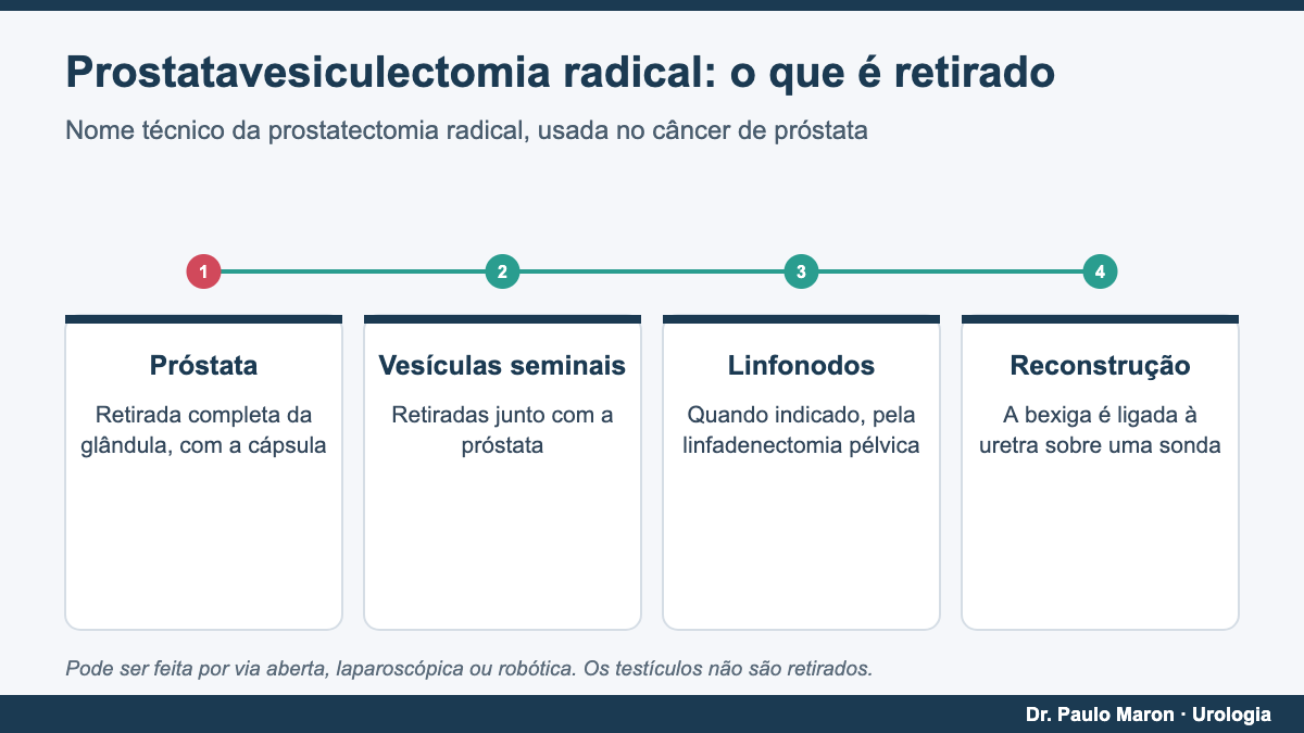 Prostatavesiculectomia radical: o que é retirado na cirurgia do câncer de próstata